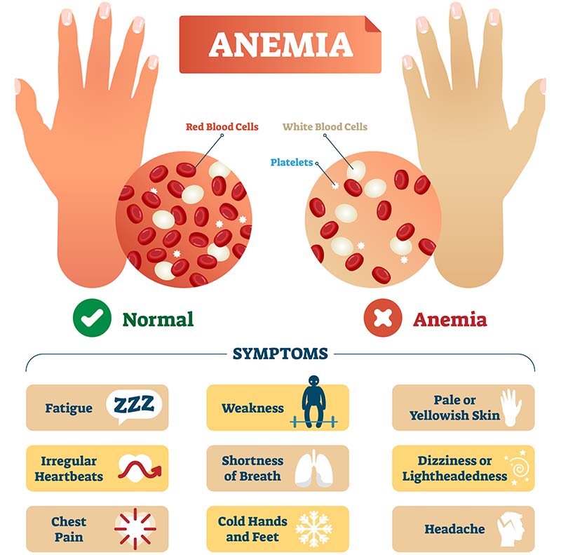 Anemia & its symptoms, Via: healthscopemag.com